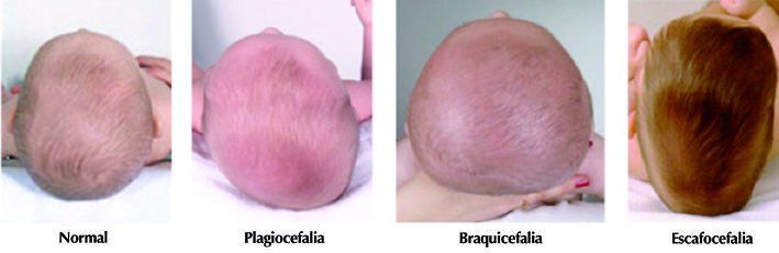 plagiocefalia, braquicefalia, escafocefalia y deformidades craneales: cojin  mimos - ACB